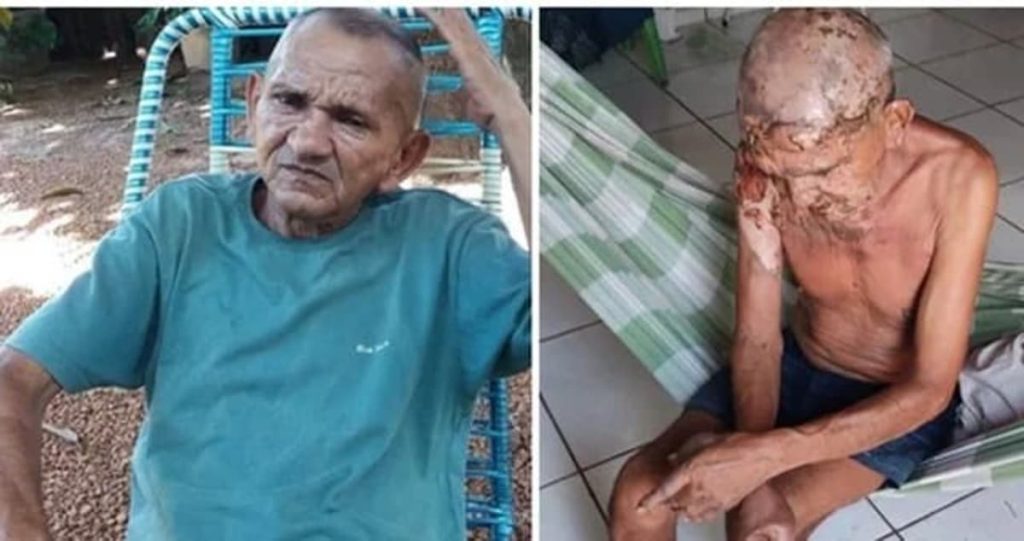 Em discussão durante bebedeira, mulher ateia fogo em idoso em José de Freitas