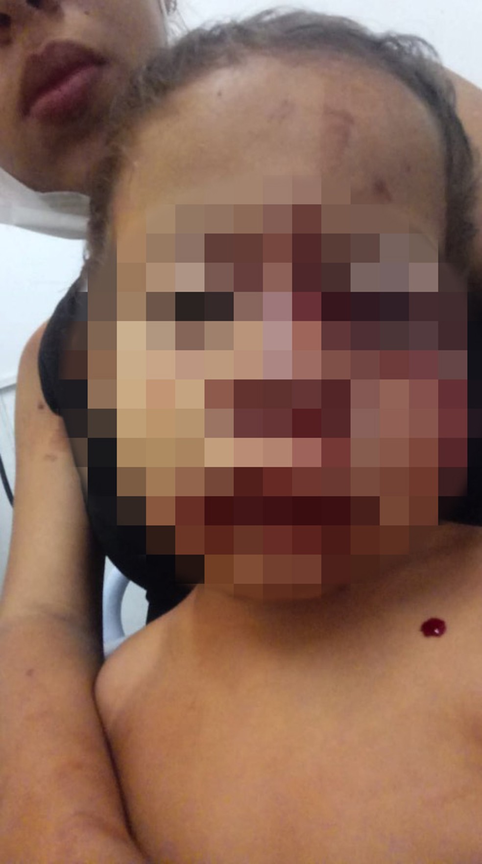 Família pede ajuda no Piauí após menino de 02 anos ter rosto desfigurado em ataque de cachorro