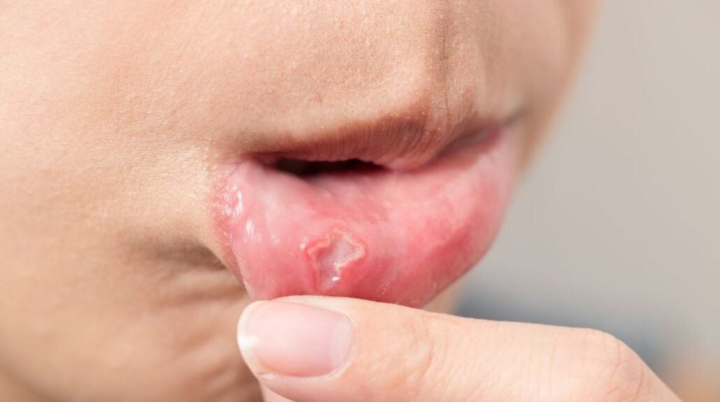 O que causa afta na boca: saiba como tratar e prevenir