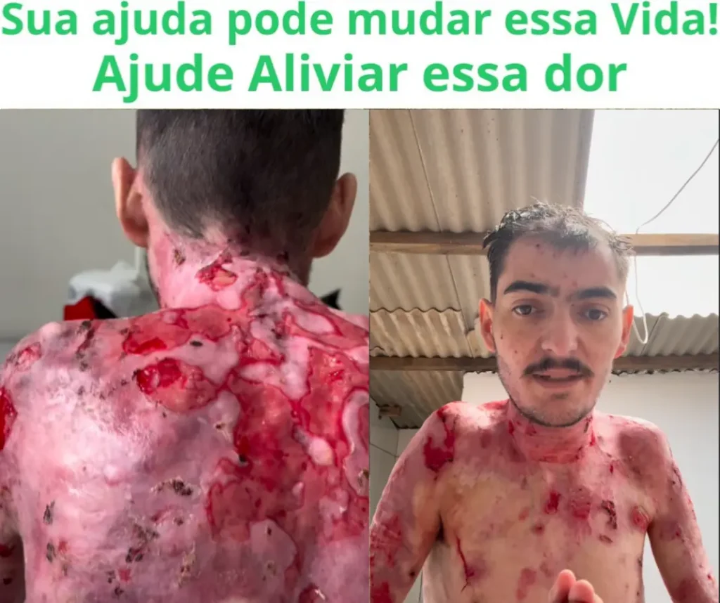 Epidermólise bolhosa em senador amaral: Homem com queimaduras graves na pele pedindo ajuda