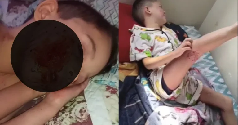 Menino de 6 anos com dermatite grave e autismo precisa de ajuda