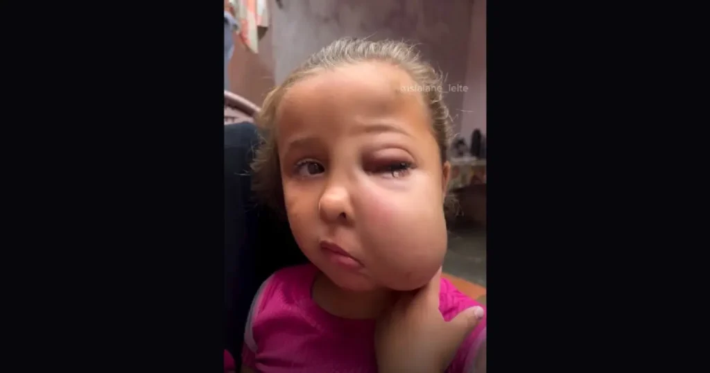 Criança com hemangioma grave no rosto: Menina com inchaço facial e ocular por tumor